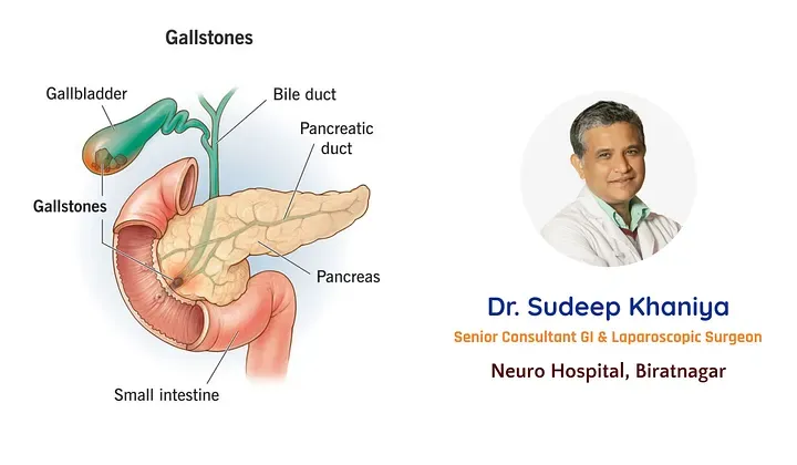 What is Gallstone Disease?
