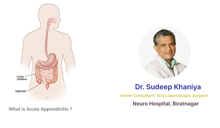 What is Acute Appendicitis ?