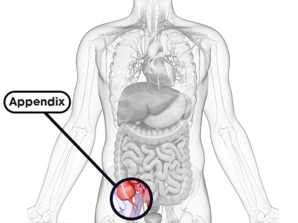 What is Appendicitis ?