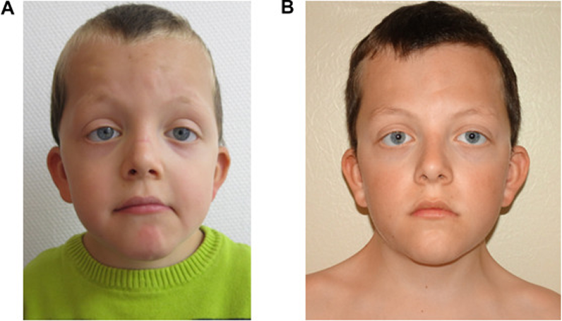What is Noonan Syndrome ?