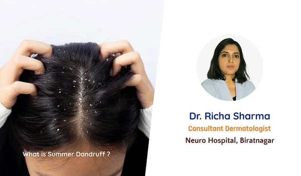 What is Summer Dandruff ?