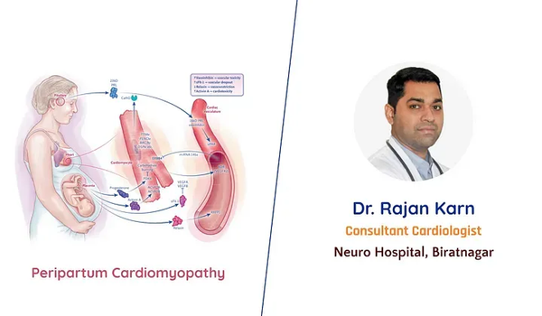 Peripartum Cardiomyopathy